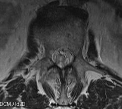 Ependymoma Conus Axial MRI